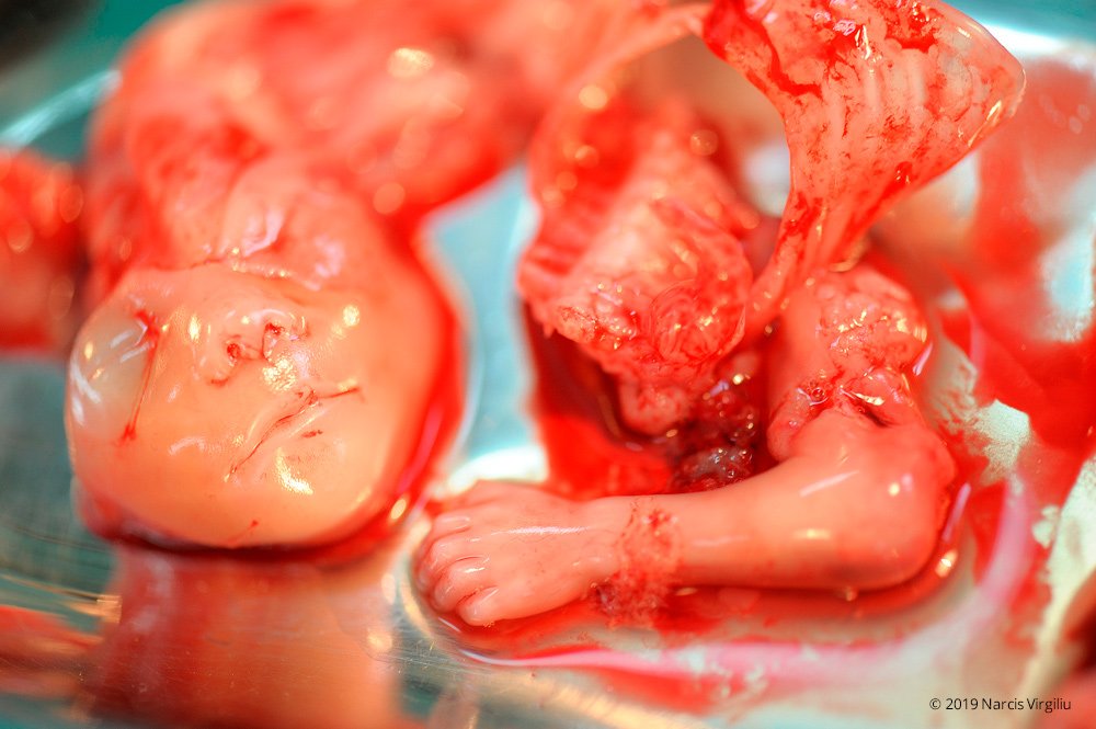 Abortion - 15 weeks